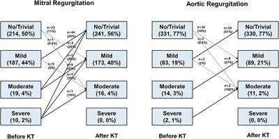 Mitral and Aortic Regurgitation in Patients Undergoing Kidney Transplantation: The Natural Course and Factors Associated With Progression